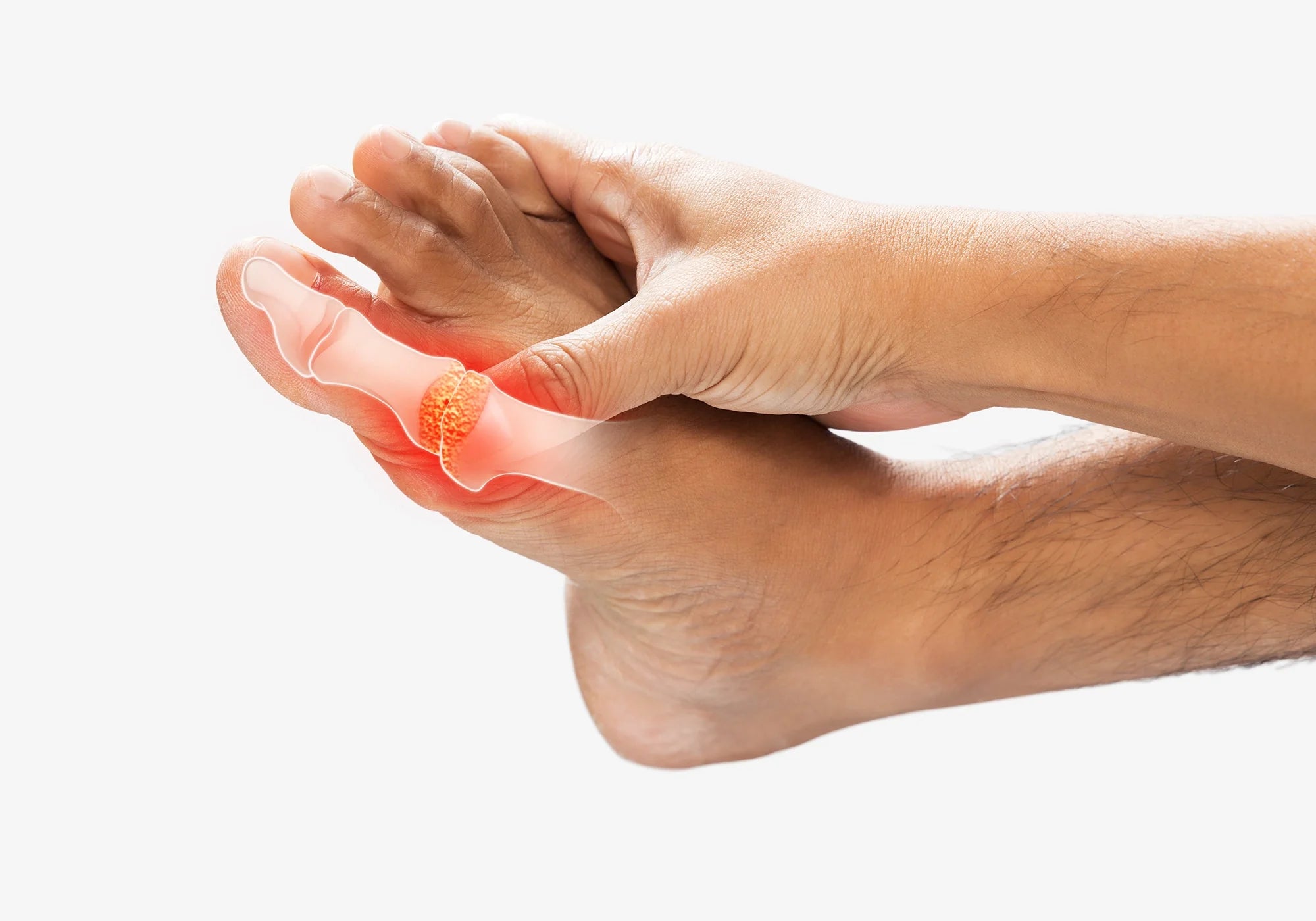 Подагра: Същност, симптоми и стадии на развитие